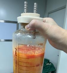 武穴水动力吸脂手术要做多久？